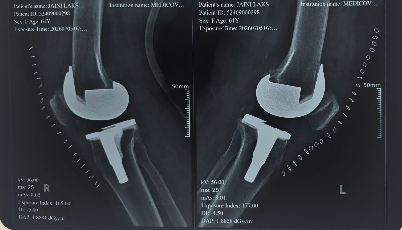 After knee replacement close-up X-ray